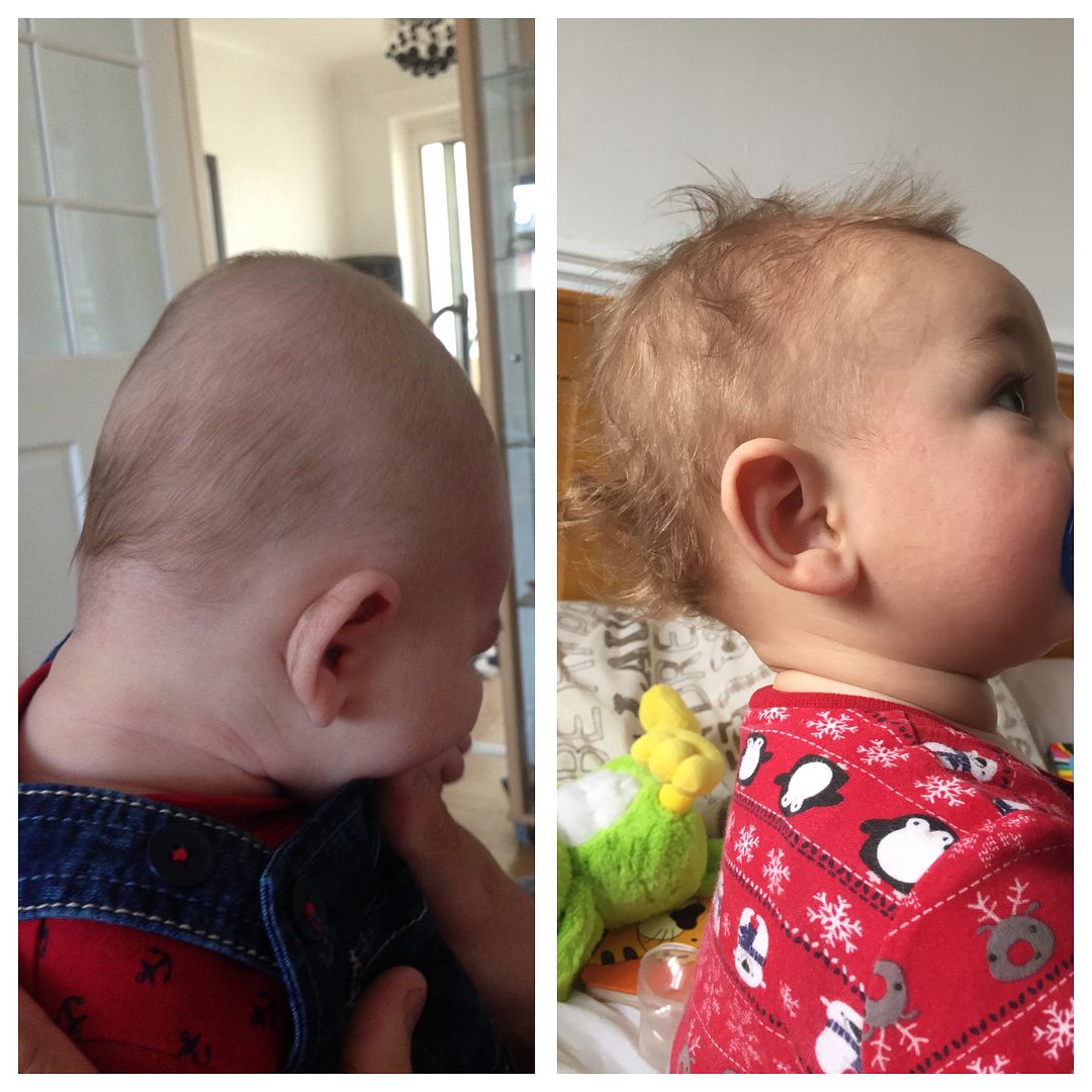 His head corrected itself ) Plagiocephaly / Flat Head Syndrome